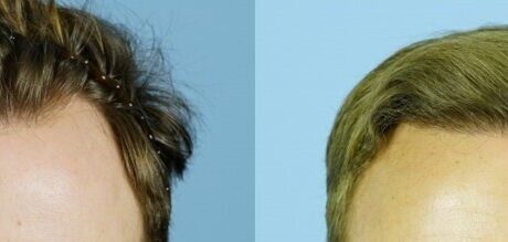 hairline restoration before and after