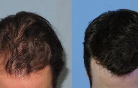 before and after