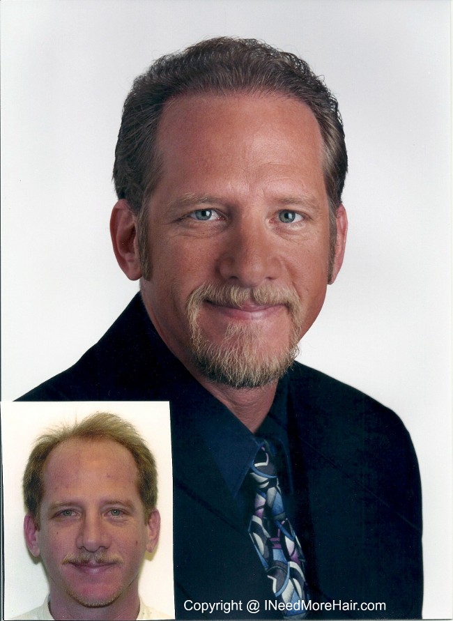 before and after Hair transplant Patient Testimonials