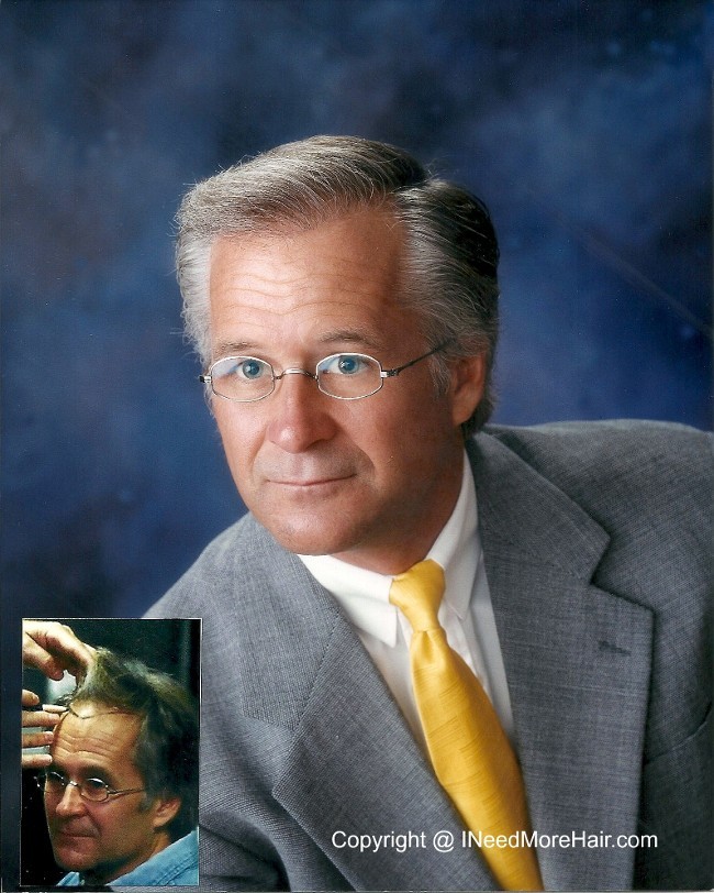before and after Hair transplant Patient Testimonials