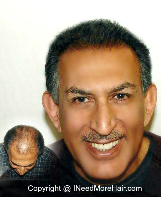 before and after Hair transplant