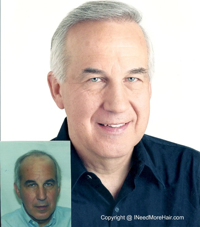 before and after Hair transplant Patient Testimonials