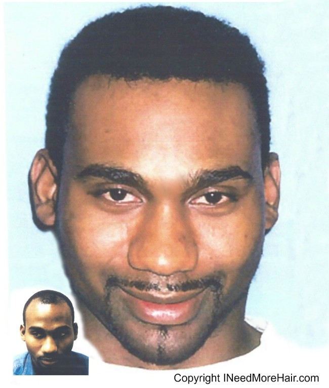before and after Hair transplant Patient Testimonials
