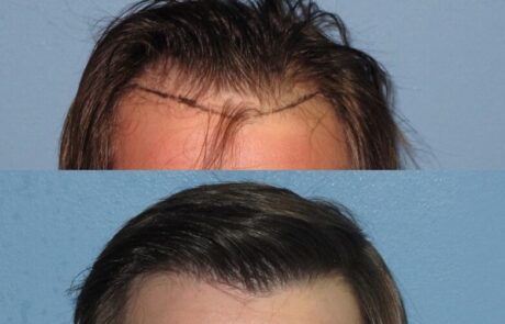 before and after Hair transplant