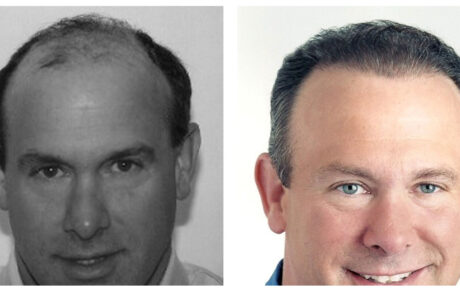 before and after Hair transplant