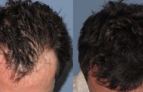 hairline restoration before and after