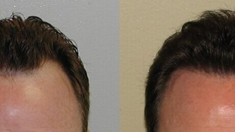 hairline restoration before and after