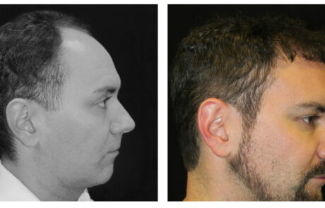 before and after Hair transplant