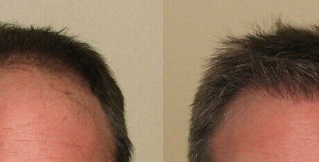 hairline restoration before and after