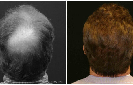 before and after Hair transplant