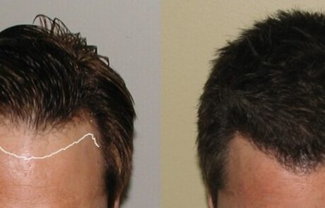hairline restoration before and after