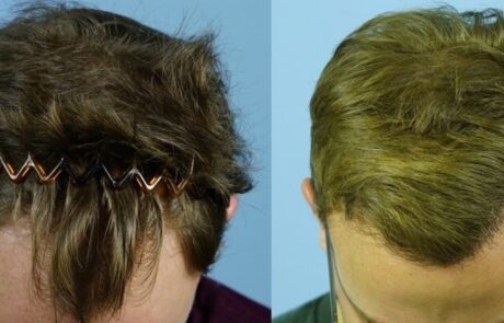 hairline restoration before and after