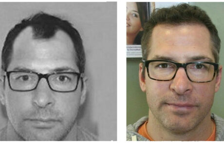 before and after Hair transplant