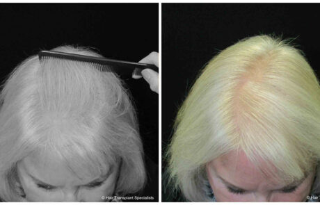before and after Hair transplant