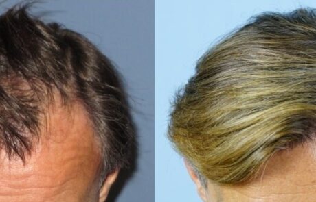 before and after
