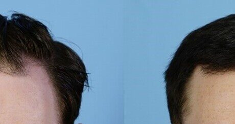 before and after