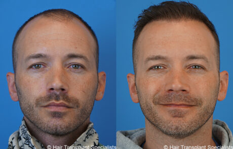 before and after Hair transplant