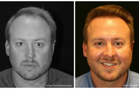 before and after Hair transplant