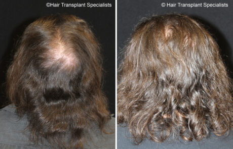 before and after Hair transplant