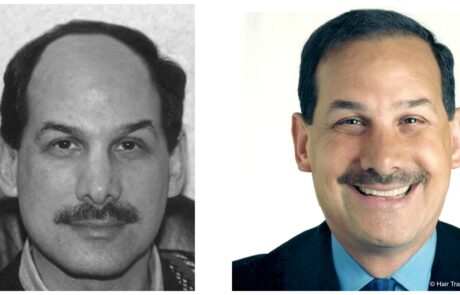 before and after Hair transplant
