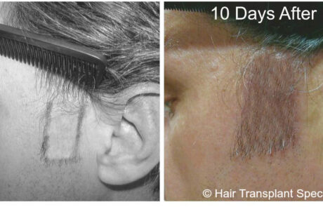 before and after Hair transplant