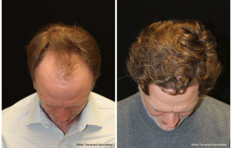 before and after Hair transplant