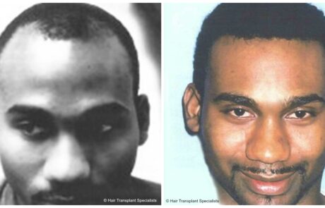 before and after Hair transplant