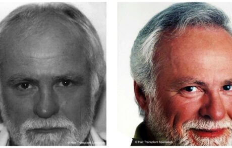 before and after Hair transplant