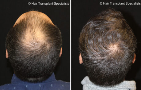 before and after Hair transplant