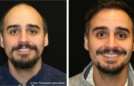before and after Hair transplant