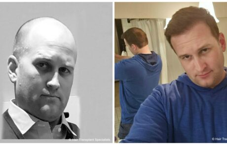before and after Hair transplant