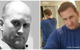 before and after Hair transplant