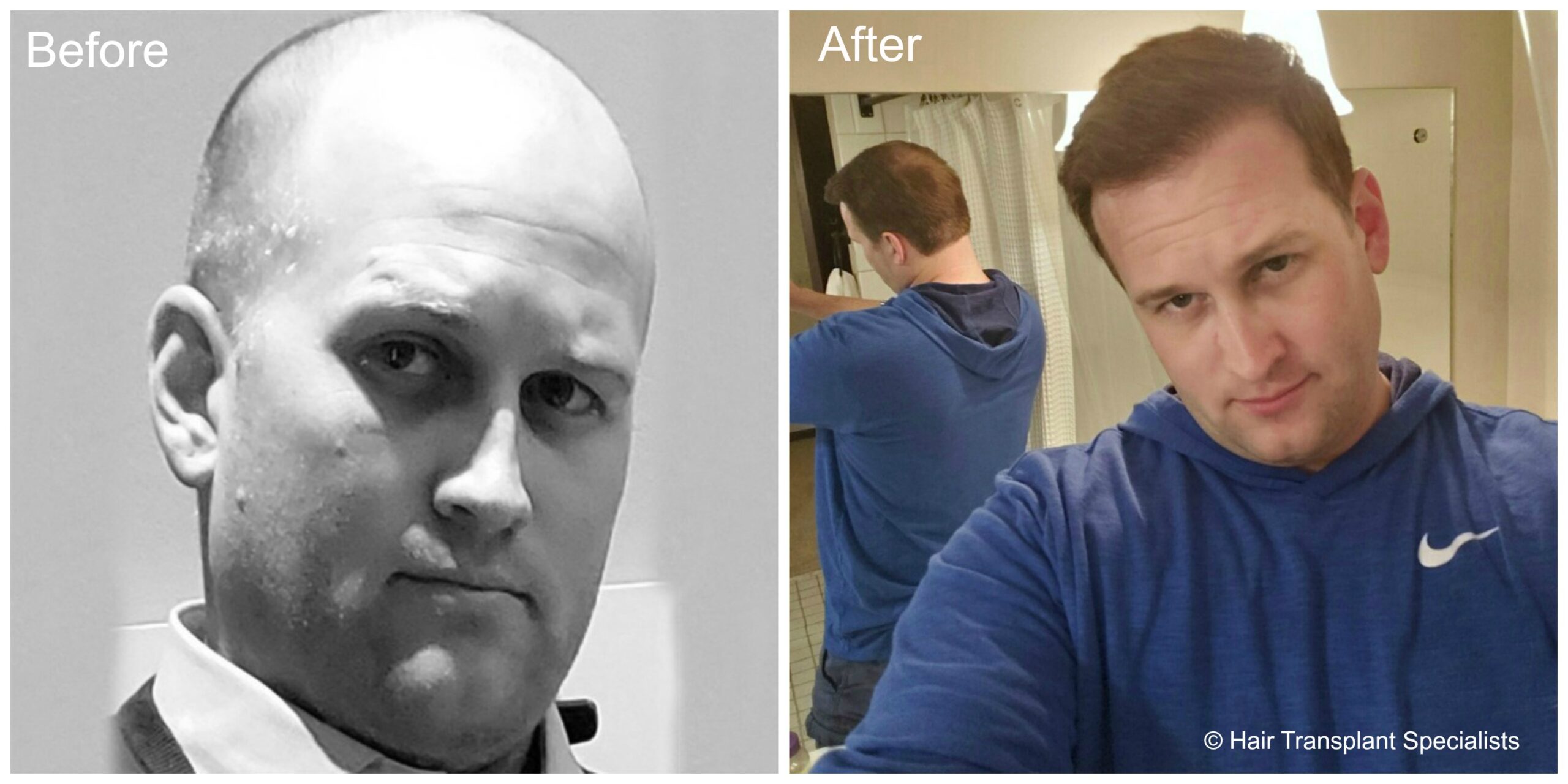 before and after Hair transplant