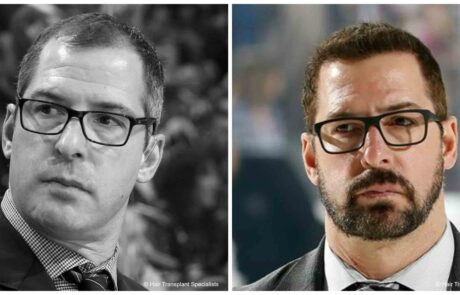 before and after Hair transplant