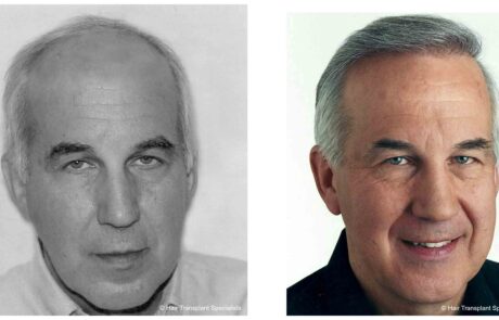 before and after Hair transplant