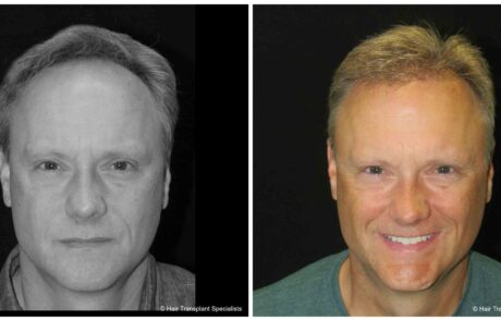 before and after Hair transplant
