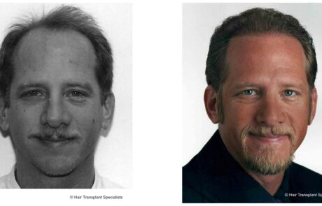 before and after Hair transplant