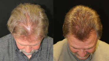 before and after